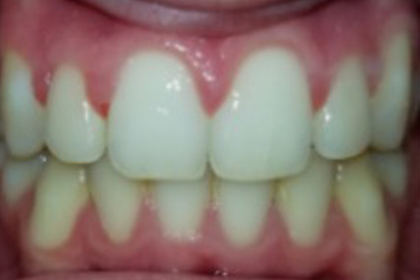 Close-up of front teeth showing proper dental alignment and white tooth color against pink gums.