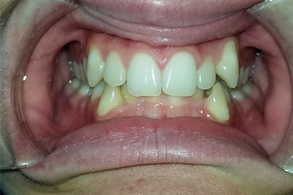 Close-up of open mouth showing upper and lower teeth with visible dental issues and discoloration.