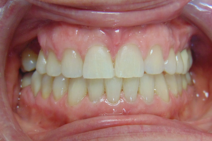 Close-up view of upper and lower teeth showing dental alignment and bite relationship in clinical setting.