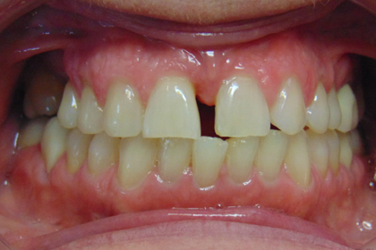 Close-up dental view showing upper and lower teeth with visible gaps and discoloration in clinical setting.