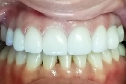 Close-up of dental work showing upper and lower teeth with white crowns or veneers in a clinical setting.