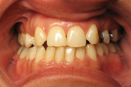 Close-up of teeth showing discoloration, wear, and misalignment in need of dental treatment.