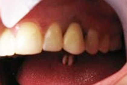 Close-up of upper teeth showing discoloration and gaps between front teeth in oral cavity.