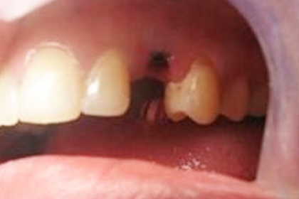 Open mouth showing upper front teeth with visible gap between central incisors, dental setting.
