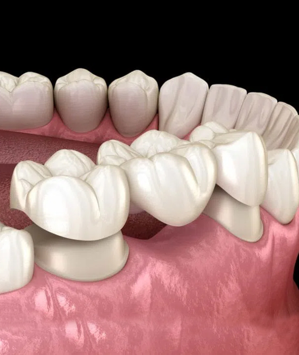 3D dental illustration showing tooth implants and crowns on pink gum model.