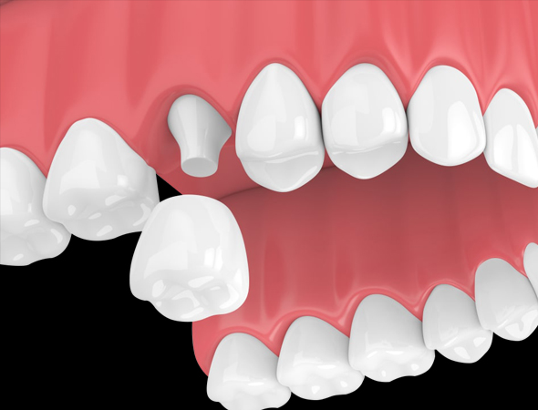 3D dental illustration showing white tooth models arranged against pink and black background demonstrating tooth positioning.