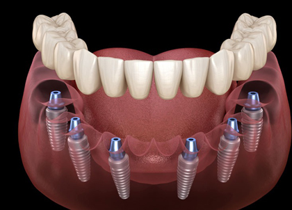 Dental implants model showing prosthetic teeth on implant posts in jawbone structure.
