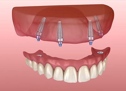 Dental implant diagram showing upper jaw prosthesis with three titanium screws and lower teeth model against pink background.