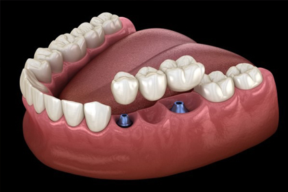 3D dental model showing implant placement in lower jaw with prosthetic teeth restoration