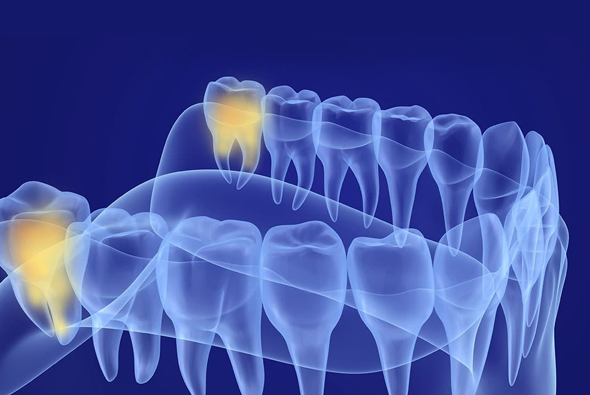 X-ray style dental illustration showing upper and lower teeth with glowing canine teeth highlighted in yellow against blue background.