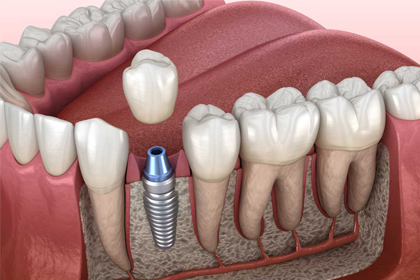 Dental implant diagram showing titanium screw placement in jawbone with adjacent teeth model.