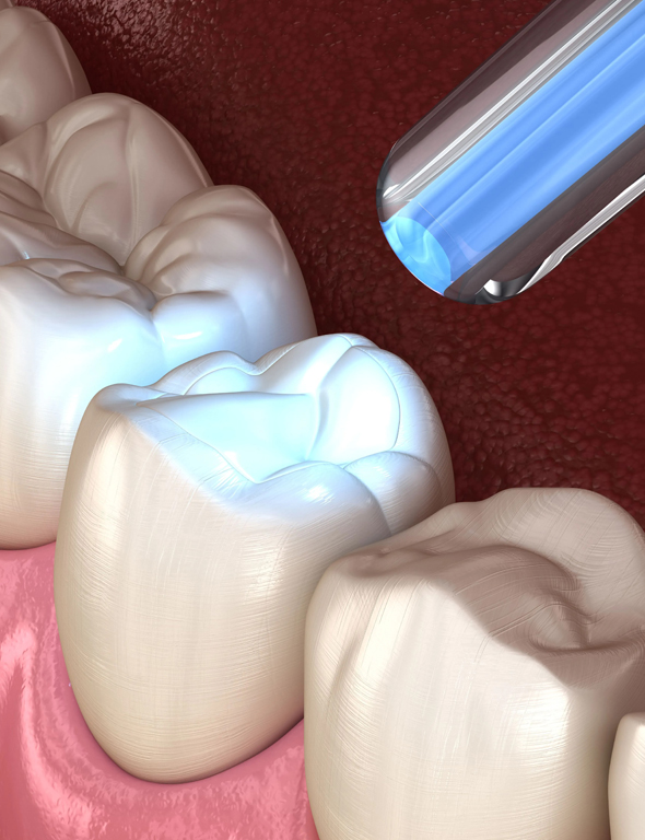 Dental model showing tooth preparation with blue LED curing light for restorative treatment.