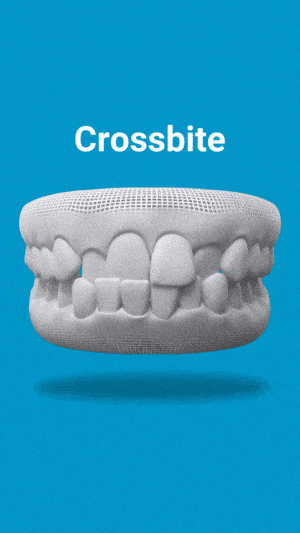 3D dental model showing crossbite malocclusion against blue background with label.
