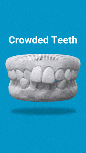 Dental model displaying crowded teeth condition against blue background with white text label.