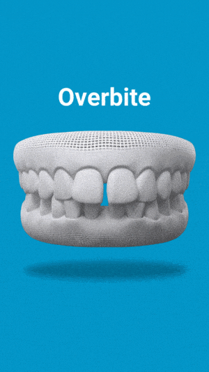 Dental model showing overbite malocclusion on blue background with white text label above